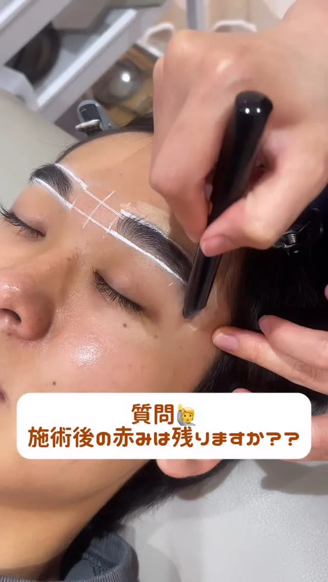 施術後の赤みは残るの？？